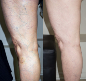 Telangectasias tratadas con sesiones de Escleroterapia