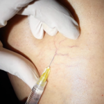 especialista en varices Escleroterapia Eco-guiada y Visual