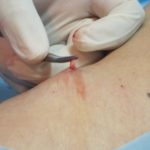 especialista en varices flebectomia